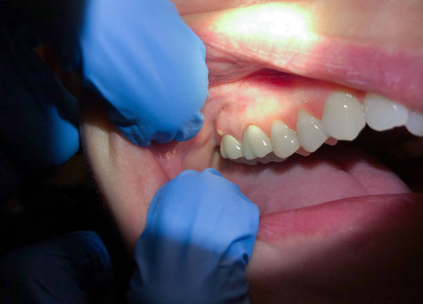 Best Walk-In Emergency Dentist in Milton, WA